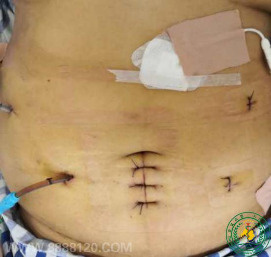 Ƴɹչȫǻʮָ(whipple)