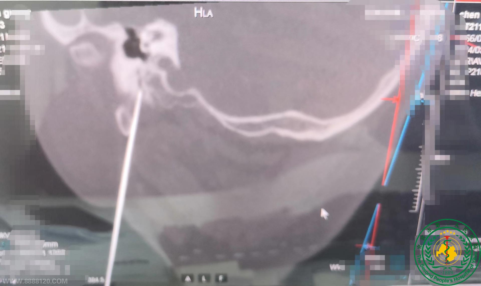 ˱ҽԺ˱ɹչCT¾ƤƵ