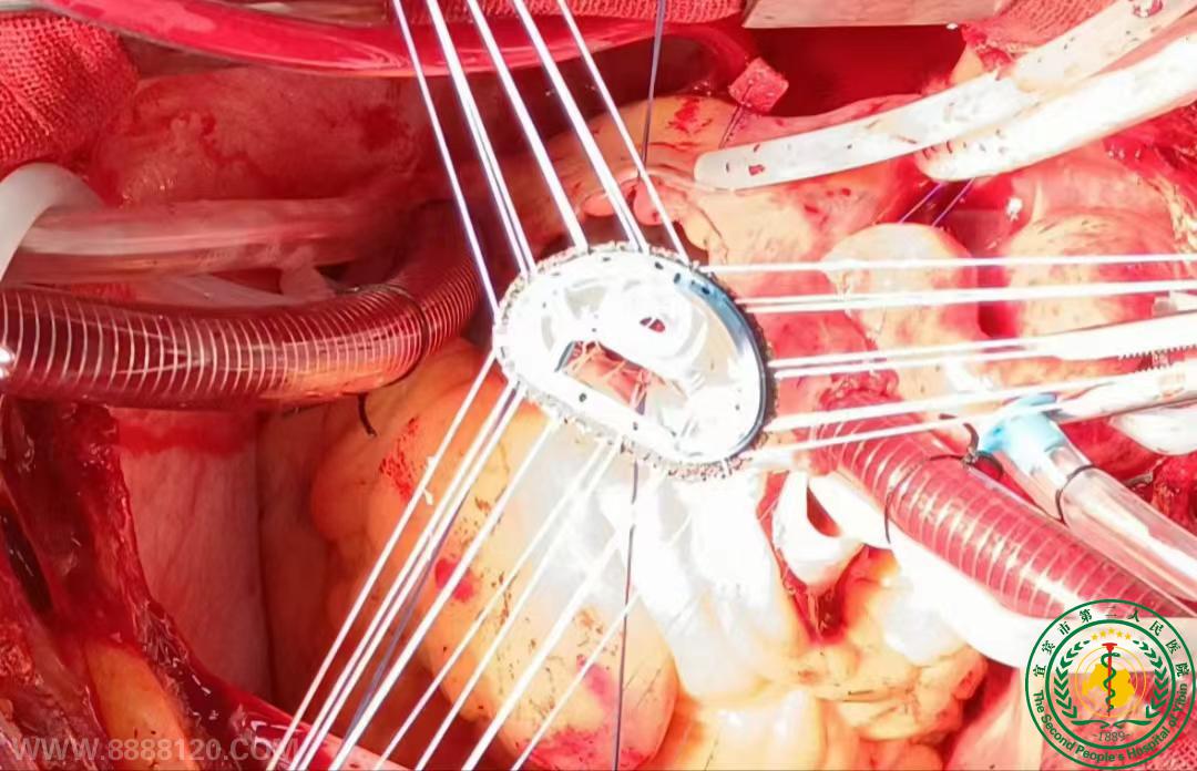 宜宾首例自主二尖瓣人工瓣环成形同期主动脉瓣置换及三尖瓣成形手术在我院成功开展