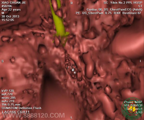 ԺCTƳزѪܣ״ζһվʽ鼼