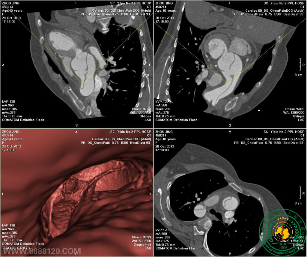 ԺCTƳزѪܣ״ζһվʽ鼼